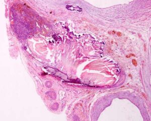 tessuto ovarico (in alto a sinistra)