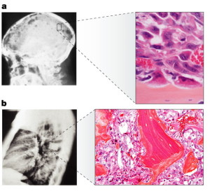 metastasi ossee, localizzate e ingrandite