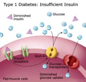 Il diagramma mostra il diabete di tipo 1
