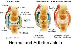 articolazione con e senza artrite reumatoide