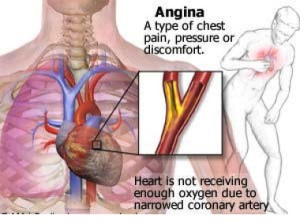 diagramma angina