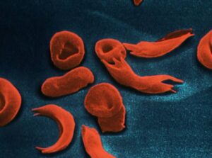 eritrociti falciformi