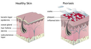 comparazione pelle sana e pelle con psoriasi