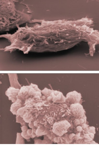 cellule del melanoma: in alto benigno, in basso invece maligno