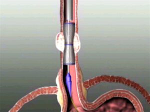 stent esofageo in presenza di un restringimento causato da una massa tomurale