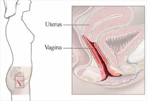 anatomia area vaginite atrofica