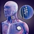 stimolazione tramite dispositivo tipo pacemaker