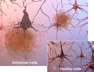 Sx: placche amiloidi dell'Alzheimer. dx: cellule sane