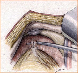 dissezione uretra