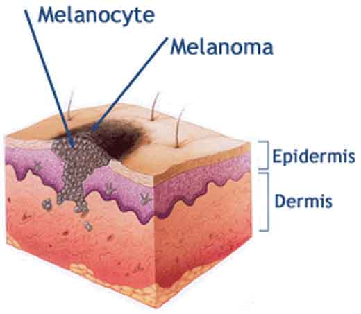 diagramma melanoma - melanociti