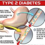 Diabete tipo 2: uso di glifozine entro due anni dalla diagnosi cancella ‘memoria metabolica’ e protegge dal rischio cardiovascolare