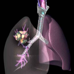 lung_cancer