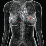 Tumore al seno: la “Breast Academy” di GE HEALTHCARE compie dieci anni