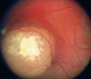 retinoblastoma1