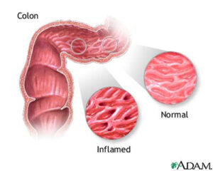 crohn-disease
