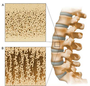 htn-osteoporosis