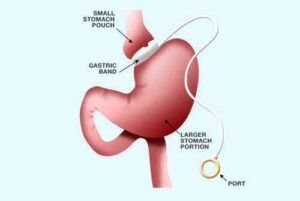 gastric-banding
