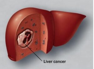 liver_cancer