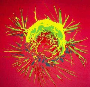 cellule_cancerose