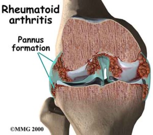 artrite_reumatoide
